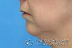 Chin Implants