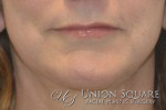 Chin Implants