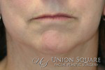 Chin Implants