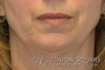 Chin Implants