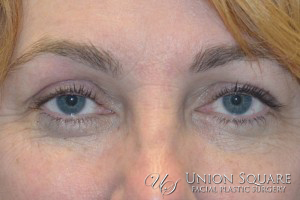 Blepharoplasty