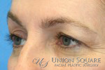 Blepharoplasty