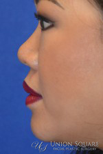 Non Surgical Rhinoplasty