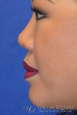 Non Surgical Rhinoplasty