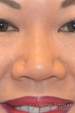 Non Surgical Rhinoplasty