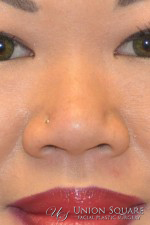 Non Surgical Rhinoplasty