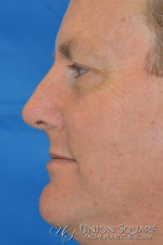 Nose Skin Cancer Reconstruction