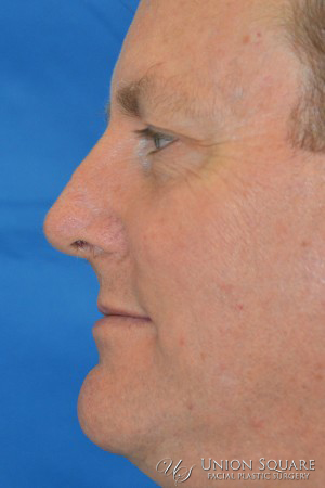 Nose Skin Cancer Reconstruction
