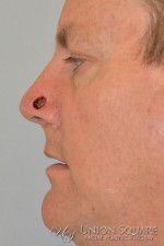 Nose Skin Cancer Reconstruction