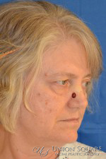 Nose Skin Cancer Reconstruction