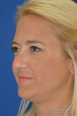 Rhinoplasty / Ethnic Rhinoplasty