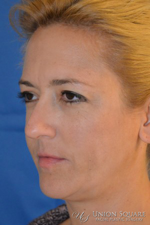 Rhinoplasty / Ethnic Rhinoplasty