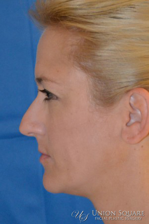 Before Rhinoplasty Photos in San Francisco by Dr. Lynn Chiu-Collins