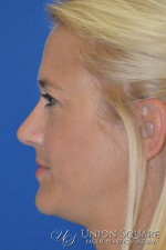 Rhinoplasty / Ethnic Rhinoplasty