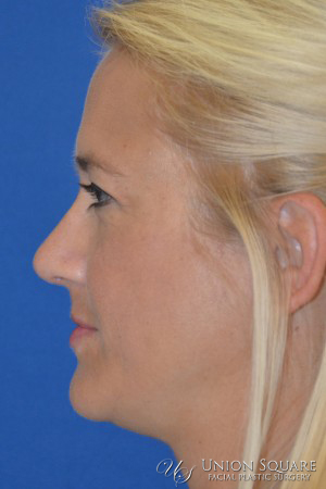 Rhinoplasty / Ethnic Rhinoplasty