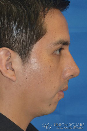 Rhinoplasty / Ethnic Rhinoplasty Case 2063 After Photo Rhinoplasty / Ethnic Rhinoplasty