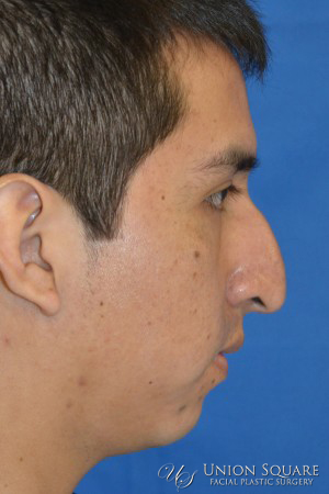 Rhinoplasty / Ethnic Rhinoplasty Case 2063 Before Photo Rhinoplasty / Ethnic Rhinoplasty