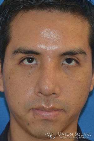 Rhinoplasty / Ethnic Rhinoplasty Case 2063 After Photo Rhinoplasty / Ethnic Rhinoplasty