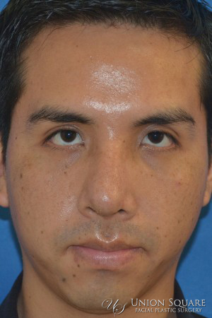 Rhinoplasty / Ethnic Rhinoplasty