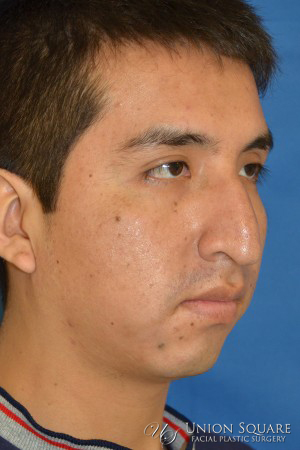 Rhinoplasty / Ethnic Rhinoplasty Case 2063 Before Photo Rhinoplasty / Ethnic Rhinoplasty