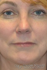 Rhinoplasty / Ethnic Rhinoplasty