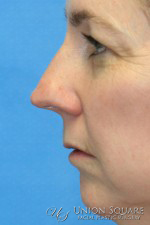 Rhinoplasty / Ethnic Rhinoplasty