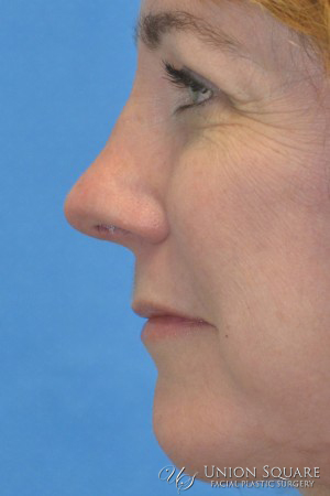 Rhinoplasty / Ethnic Rhinoplasty