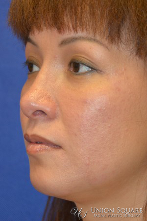 Rhinoplasty / Ethnic Rhinoplasty