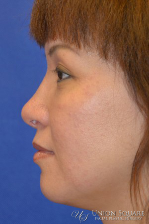 Rhinoplasty / Ethnic Rhinoplasty