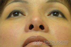 Rhinoplasty / Ethnic Rhinoplasty