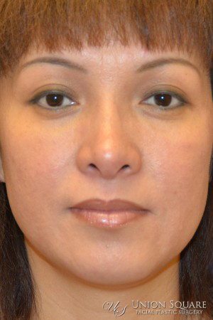 Rhinoplasty / Ethnic Rhinoplasty