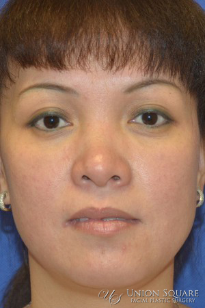 Rhinoplasty / Ethnic Rhinoplasty