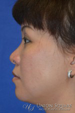 Rhinoplasty / Ethnic Rhinoplasty