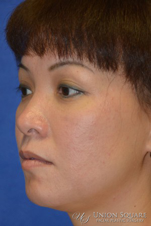 Rhinoplasty / Ethnic Rhinoplasty