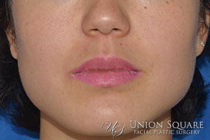 Jaw Slimming Botox