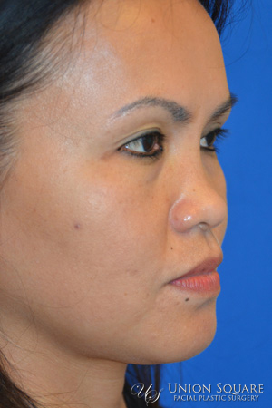 Non Surgical Rhinoplasty