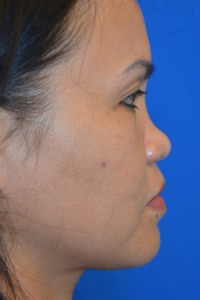 Nonsurgical Rhinoplasty Result San Francisco