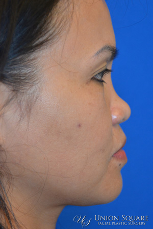 Non Surgical Rhinoplasty Results Union Square San Francisco