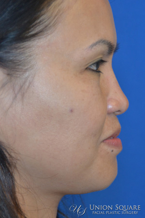 Non Surgical Rhinoplasty Results Union Square San Francisco