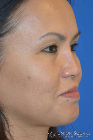 Non Surgical Rhinoplasty