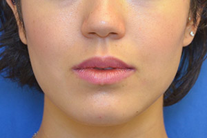 Buccal Fat Removal Results San Francisco