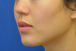 Buccal Fat Removal Results San Francisco