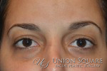 Blepharoplasty