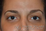 Blepharoplasty