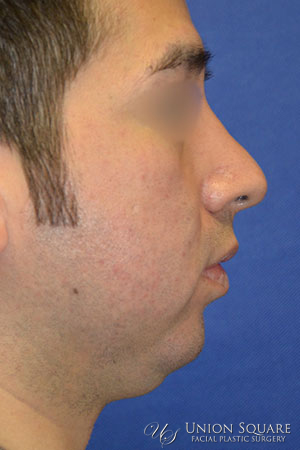 Chin Implants