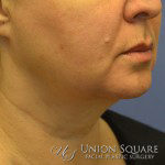 Ulthera Nonsurgical Lift