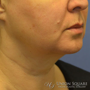 Ulthera Nonsurgical Lift