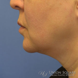 Ulthera Nonsurgical Lift