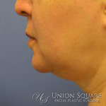 Ulthera Nonsurgical Lift