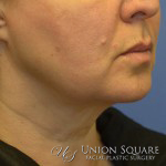 Ulthera Nonsurgical Lift